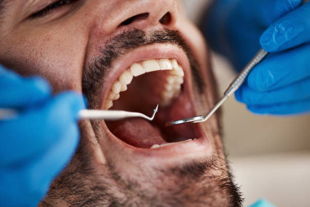 Best Emergency Wisdom Tooth Extraction in Dalhart, TX