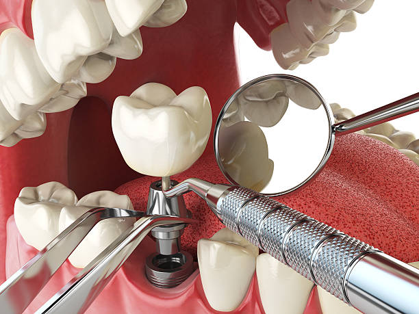 Best Emergency Wisdom Tooth Extraction in Dalhart, TX